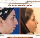 دکتر علیرضا پورصیرفی جراح بینی اصفهان