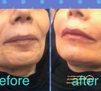 filer-face-beauty-before-after