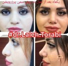doctor-laleh-torabi-nose-job-rasht