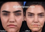 doctor-jafari-before-after-nose-job