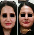 after-before-rhinoplasty-doctor-hengameh-nabaei